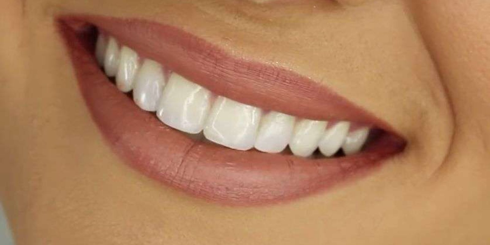 20170315043932_Smiling_Teeth