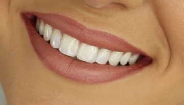 20170315043932_Smiling_Teeth